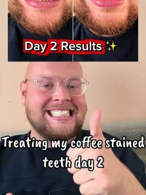 Exposing my coffee stained teeth ✨ Day 2 of teeth whitening strips @Whites Beaconsfield #teethwhitening #results #tikt