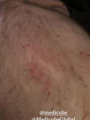 #creatorsearchinsights #creator @medicube Use Medicubes Red Body Peeling Shot Cleanser no more than 3x a week and finally get rid of your keratosis pilaris! Even after only one use, you will notice a difference!! #medicube #keratosispilaris #kp #strawberryskin #strawberrylegs #viralskincare #tts #ttsdeals #tiktokshopcybermonday #TikTokShopBlackFriday #FallDealsForvou #skincare #skintok #redbodypeelingshotcleanser #clearskin ⭐️⭐️⭐️⭐️⭐️⭐️⭐️⭐️⭐️ #TikTokShopJumpstart #TikTokShopJumpstartSale #TikTokShopLoveAtFirstFind #drmtigy #drmtigyexfoliatingpads