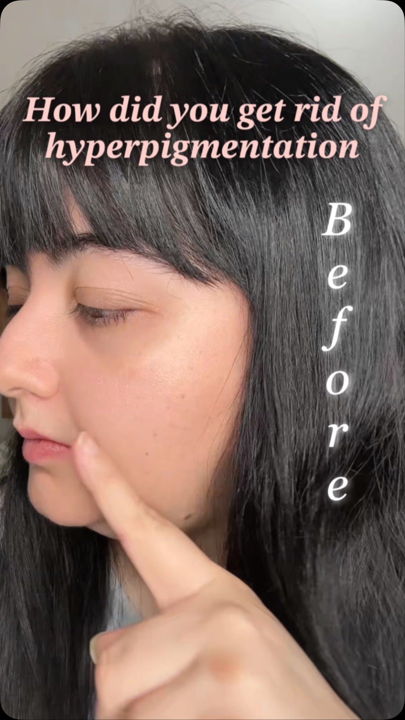 Post-acne scars? Hyperpigmentation? I feel you.
For weeks, I struggled with uneven skin tone — until I found this glow-