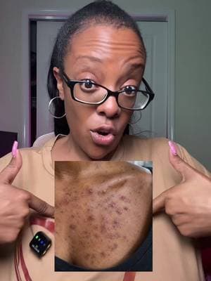 Some By Mi Body Acne Kit! #TikTokShopCreatorPicks #TikTokShopFallRestock #TikTokShopStockUp #TikTokShopRestock